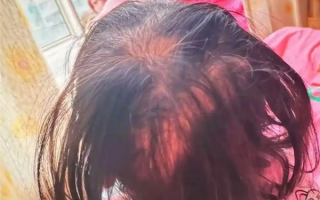 3岁女童突然脱发：查出铊中毒 眼神呆滞 ！