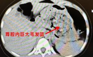 浙江一5岁女孩确诊长发公主综合征：胃里一大团头发 医生都懵了 ！