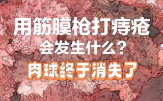 筋膜枪可以治痔疮?医生回应：会造成血管破裂，肛门损伤，勿信 ！