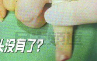 孕妇火锅店食指被切断 店长回应：不能把所有责任推到店面，只能说一人一半 ！