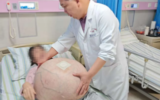 河北一女子肚子长80斤罕见巨瘤：血管暴突如蛛网 4小时切下 !