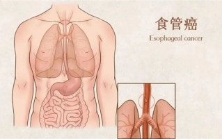 男子总拉肚子 竟查出5处癌：预防癌症 可注意这5点 ！