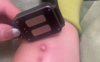 女生为考研戴电击手表叫起床被电伤：睡了12小时没被叫醒 ！