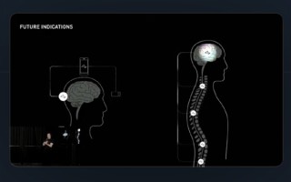 重大突破！马斯克宣布首例人类大脑芯片植入：恢复良好 ！