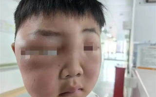 男孩一觉醒来脸肿成“发面馒头”：被蚊虫叮的面目全非 ！