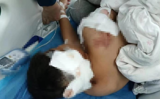 被狗咬伤男童已出ICU:耳朵缺一块，肇事主人已赔2万元 ！