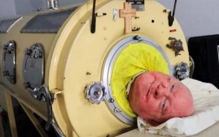 世上最后一名铁肺人去世：被困铁桶70多年 ！