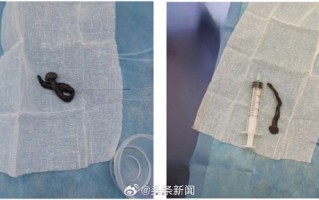 女子咳嗽半月 气管发现8cm蚂蟥：画面让网友看怕 医生科普如何避免 ！