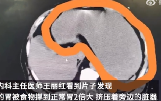 80岁老人胃被未消化食物撑大2倍：不想给儿女添麻烦，牙掉后未装假牙 ！
