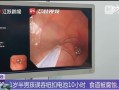 幼儿误吞电池10小时致终身残疾 医生提醒：纽扣电池卡在食道太骇人 !