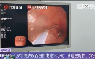 幼儿误吞电池10小时致终身残疾 医生提醒：纽扣电池卡在食道太骇人 !