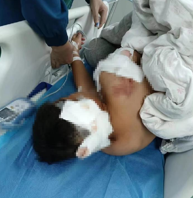 被狗咬伤男童已出ICU:耳朵缺一块，肇事主人已赔2万元 ！-第1张图片