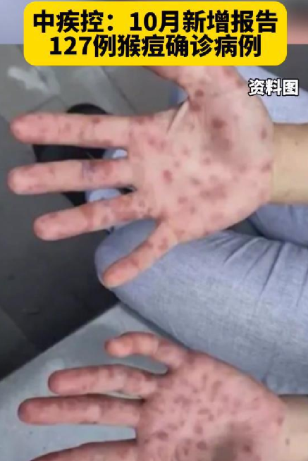 10月新增报告127例猴痘确诊病例：98.2%病例为男性 ！-第1张图片